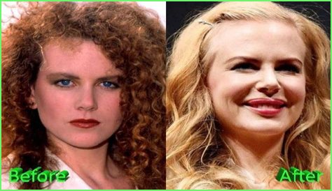Nicole Kidman's 